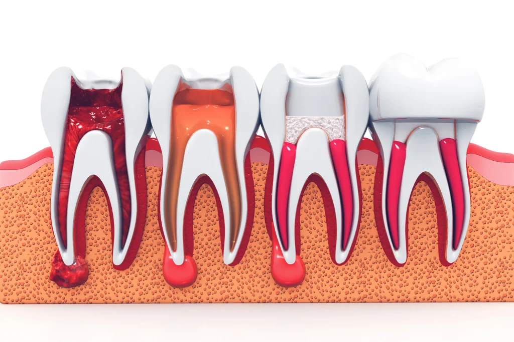3D cross-section of a tooth showing infected pulp and root canals requiring root canal treatment.