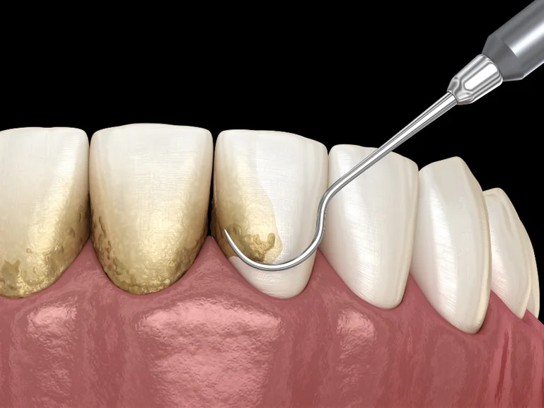 3D illustration showing before and after dental scaling and polishing to remove tartar and plaque buildup.