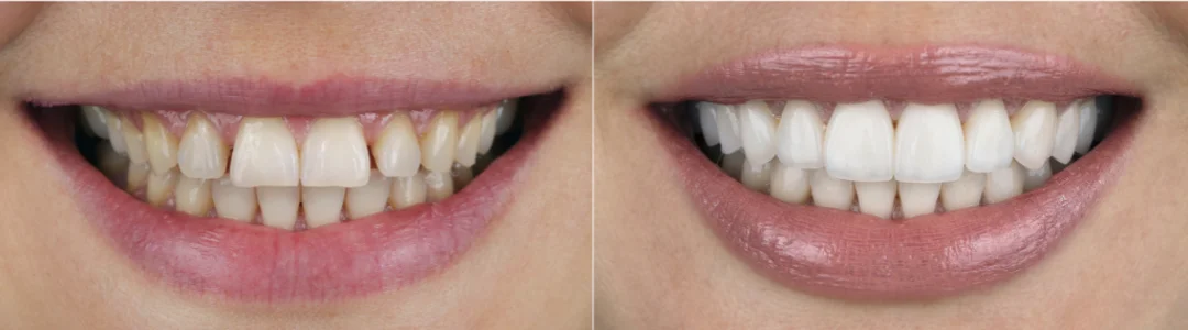 Before and after photos of veneer treatment on a young Caucasian woman.
