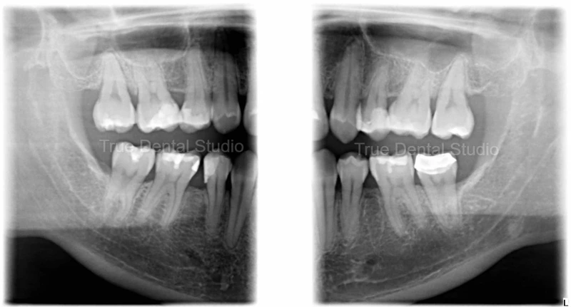 Bitewing X-Ray image of patient's teeth.