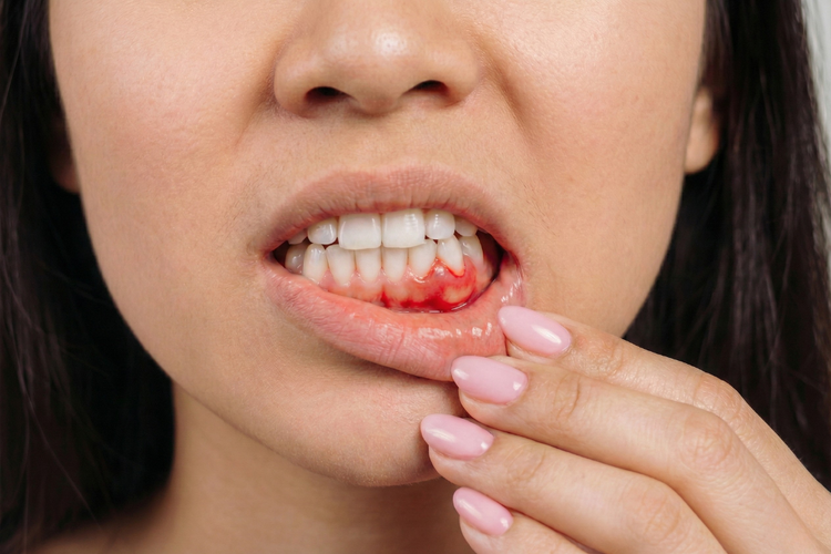 Woman revealing bleeding and swollen gums, a common symptom of gum inflammation.