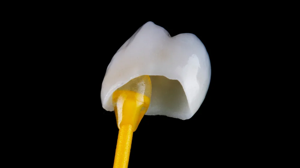 Close-up of a dental crown, which fully encases a damaged tooth, restoring both appearance and functionality.