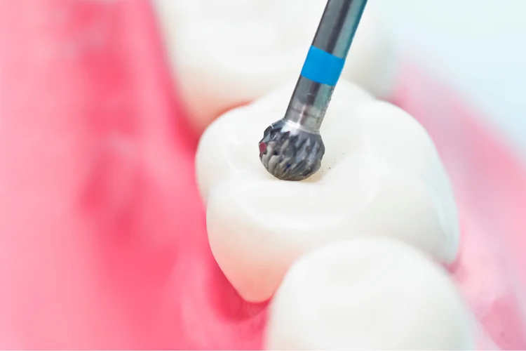 Close-up of a tooth being reshaped using a dental drill to prepare for a dental crown fitting.
