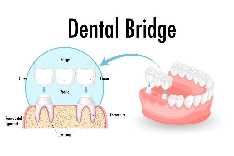 Infographic of how a dental bridge is fitted during a dental bridge procedure.