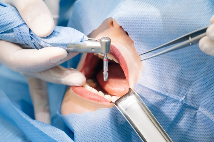 Patient undergoing dental implants procedure.