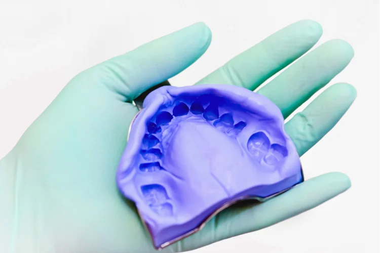 Dental impression of teeth taken from a patient to be sent to a dental lab for custom-made porcelain veneers.