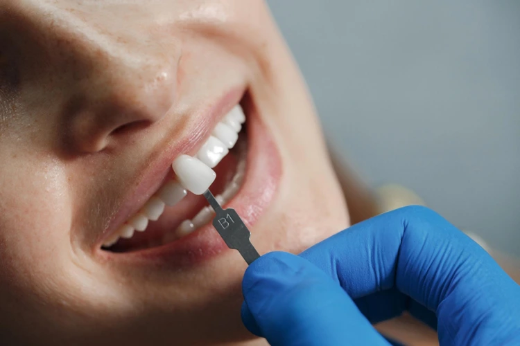Close up view of dentist applying dental veneers on a patient's front tooth.