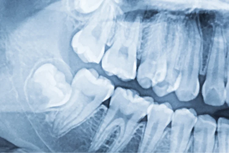 Dental X-ray showing impacted molar and crowded teeth for orthodontic assessment.