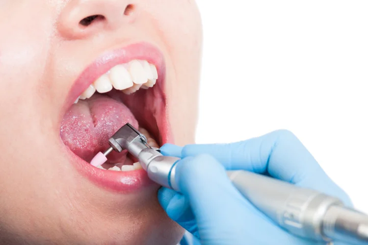 Close-up of dentist using rotary polishing tool to clean teeth during professional scaling and polishing.