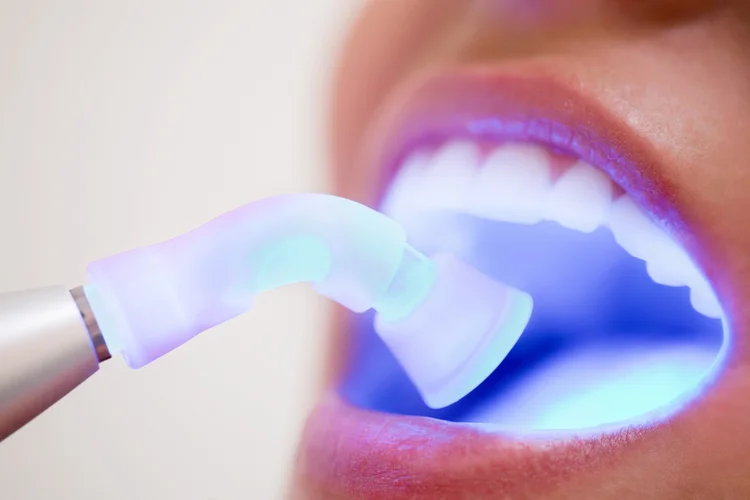 Dentist using LED light to harden resin composite after shaping and sculpting to form composite veneer on a woman's teeth.