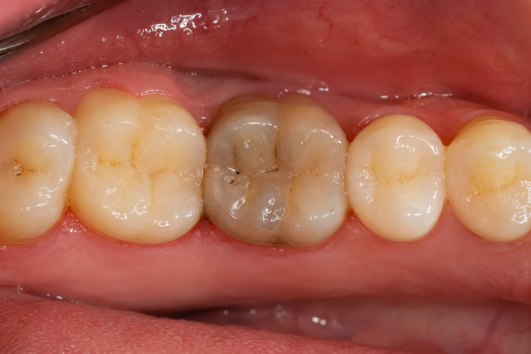 Grey discoloured dead tooth among healthy molars in the lower jaw.