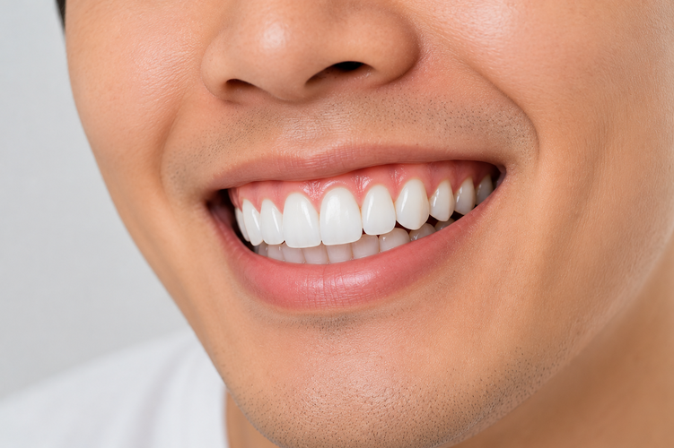 Close-up of a healthy smile with an even gumline after gum contouring.
