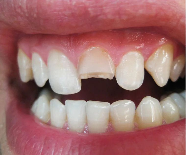 Fractured front tooth with enamel loss, potentially needing treatment like dental crowns.