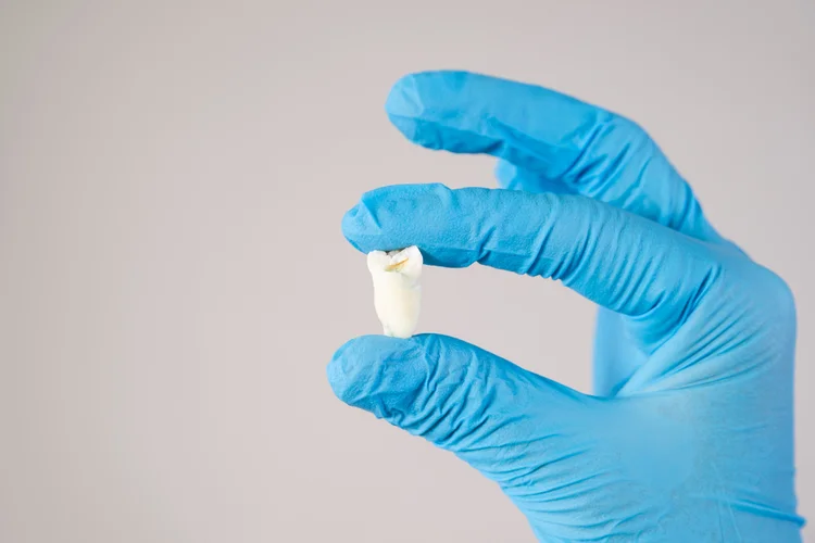 Gloved hand holding extracted wisdom tooth to illustrate removal before postoperative aftercare.