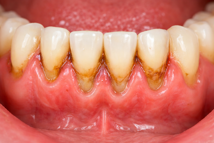 Close-up photo of lower teeth with tartar buildup, inflamed and receding gums.