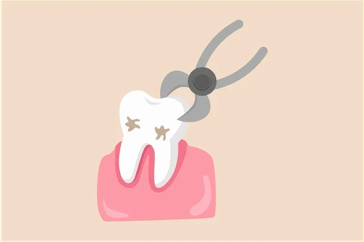 Illustration of dental forceps extracting a decayed tooth to show tooth extraction procedure.