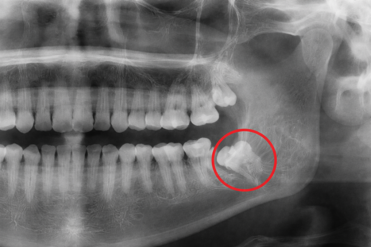 Dental X-ray showing an impacted wisdom tooth circled in the lower jaw.