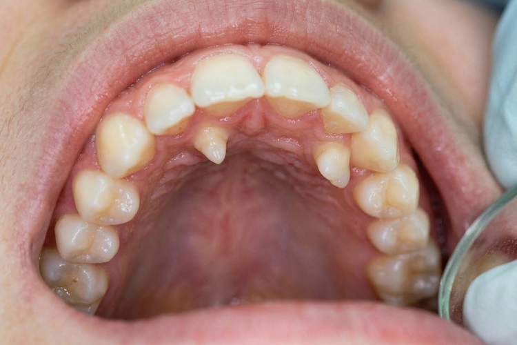 Intraoral view showing mesiodens supernumerary teeth behind the front teeth.