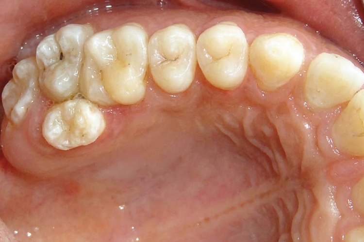 Intraoral photograph showing the upper dental arch with an extra molar.