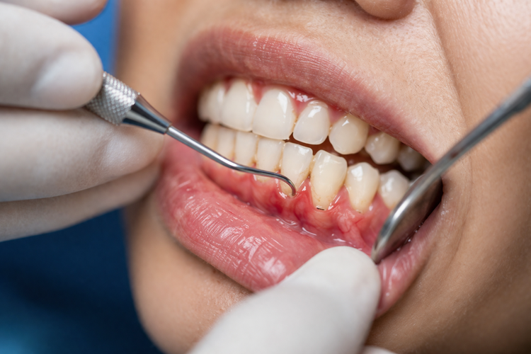 Receding gums and tartar buildup on lower teeth showing signs of periodontitis.