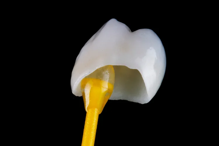Porcelain dental crown on applicator showing tooth shaped cap used to restore damaged weakened tooth.