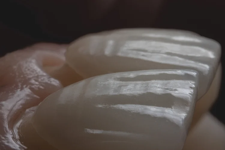 Porcelain veneers require a multi-step customisation process to ensure a precise and seamless fit onto the patient’s tooth, necessitating more than one dental visit.
