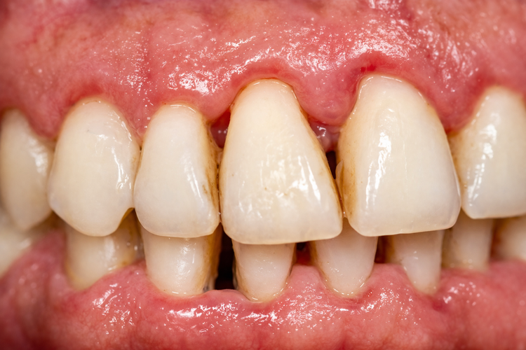 Receding gums and tartar buildup on lower teeth showing signs of periodontitis.