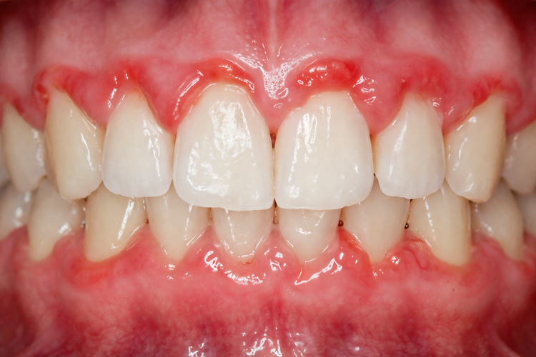 Close-up of red and swollen gums around upper and lower teeth with gingivitis.
