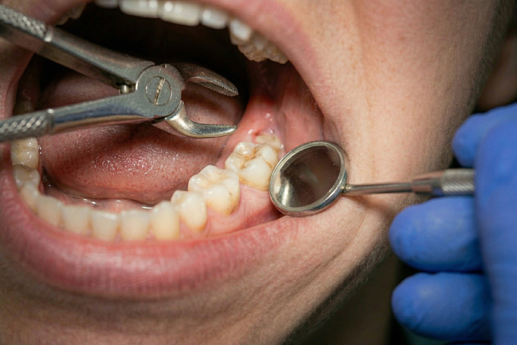 Dentist using forceps to perform a surgical tooth extraction on a molar tooth.