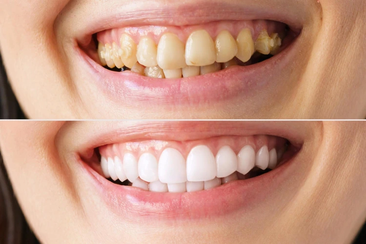 Before and after pictures of a lady having her yellow teeth becoming white after going for teeth whitening treatment.