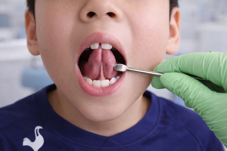 Dentist examining tongue-tie ankyloglossia in child during routine check-up.