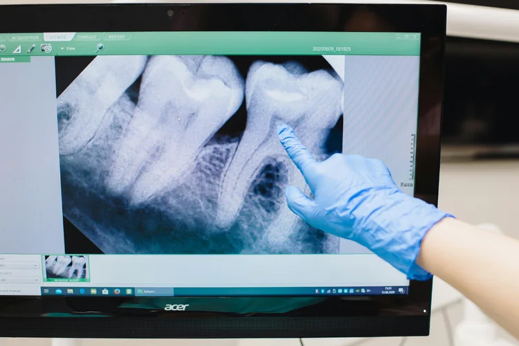 Dentist pointing at dental x-ray showing possible cracked tooth needing evaluation.