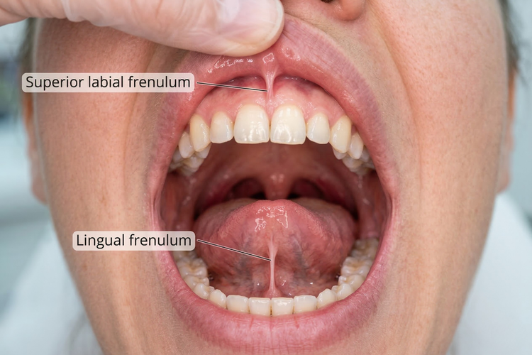 Diagram showing where the labial and lingual frenum are located inside the mouth.