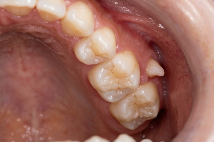 Intraoral view showing a paramolar supernumerary tooth beside the molars.