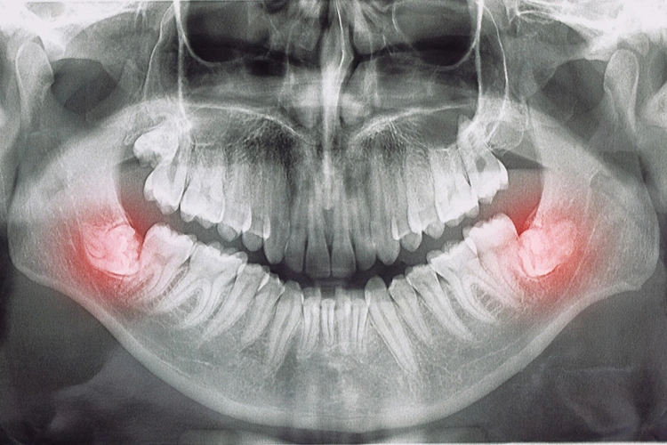 X-Ray image of 2 wisdom tooth causing problems to patient's dental well-being.