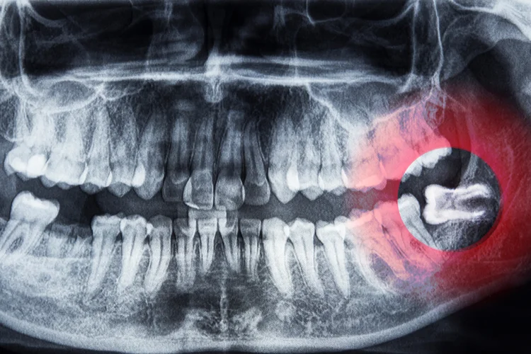 X-ray image highlighting impacted lower wisdom tooth with red inflammation in jawbone region.