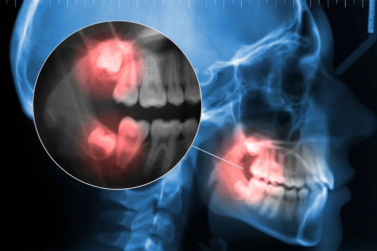 Close-up of X-ray showing wisdom teeth indicating common causes of wisdom tooth pain such as pericoronitis and impaction.