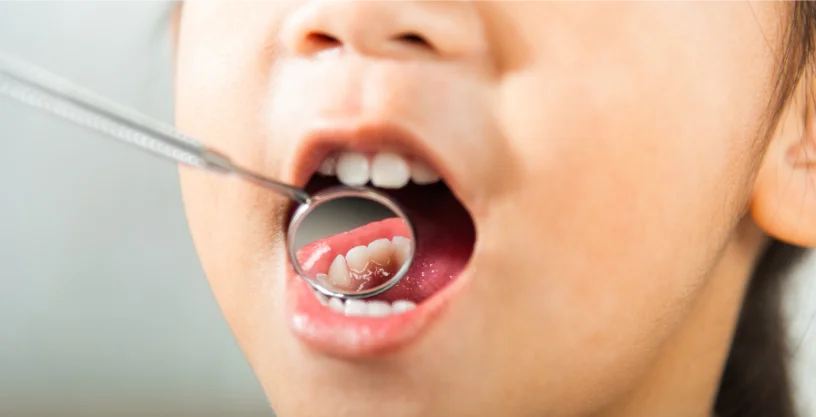 Young child undergoing dental checkup to monitor primary teeth and eruption patterns.